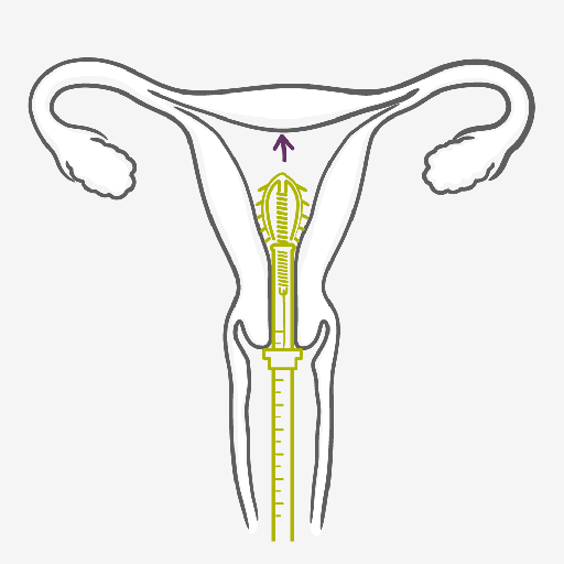 How does the Intrauterine Device - IUD work