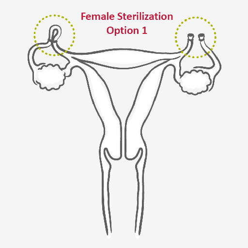 female sterilization surgical