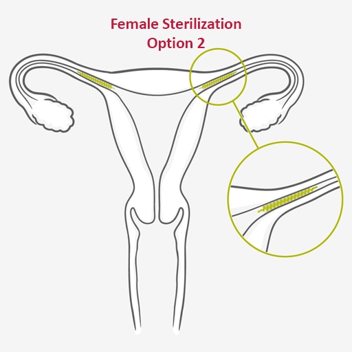 female sterilization non-surgical