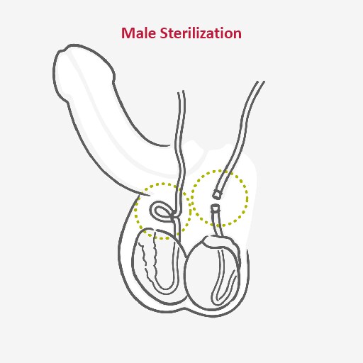 male sterilization