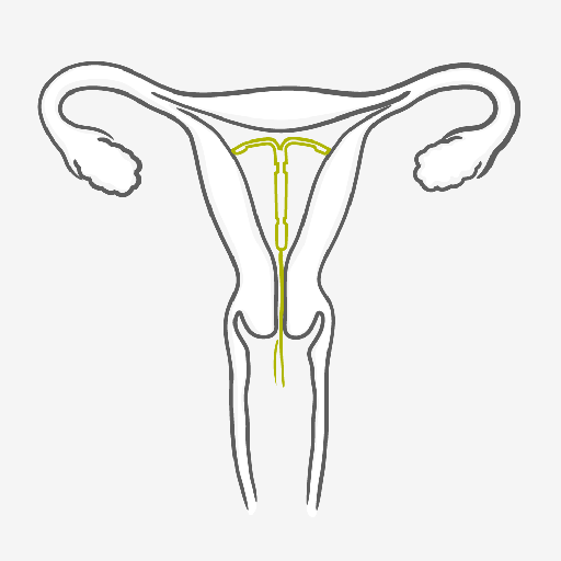 Cómo usar el Sistema Intrauterino – SIU