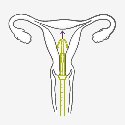 Cómo actúa el Sistema Intrauterino