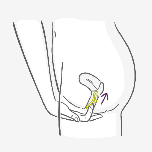 Comment insérer l’anneau vaginal