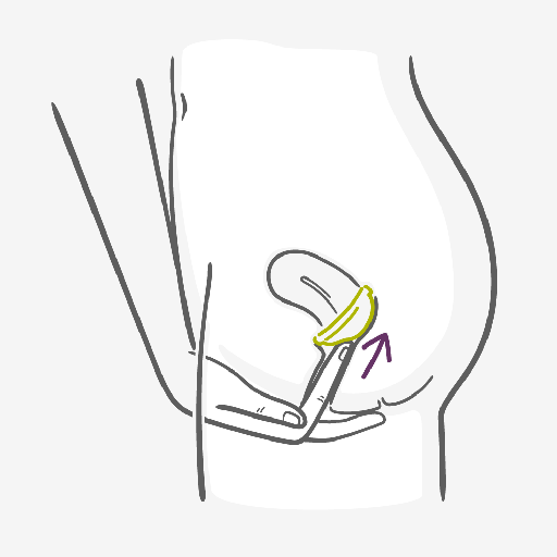 Fold the diaphragm in half and slide it up into your vagina