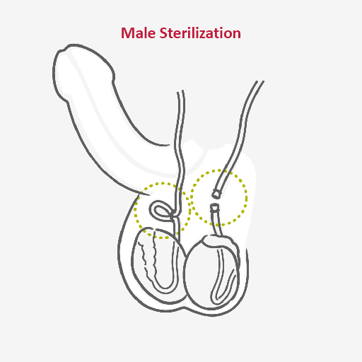 male sterilization